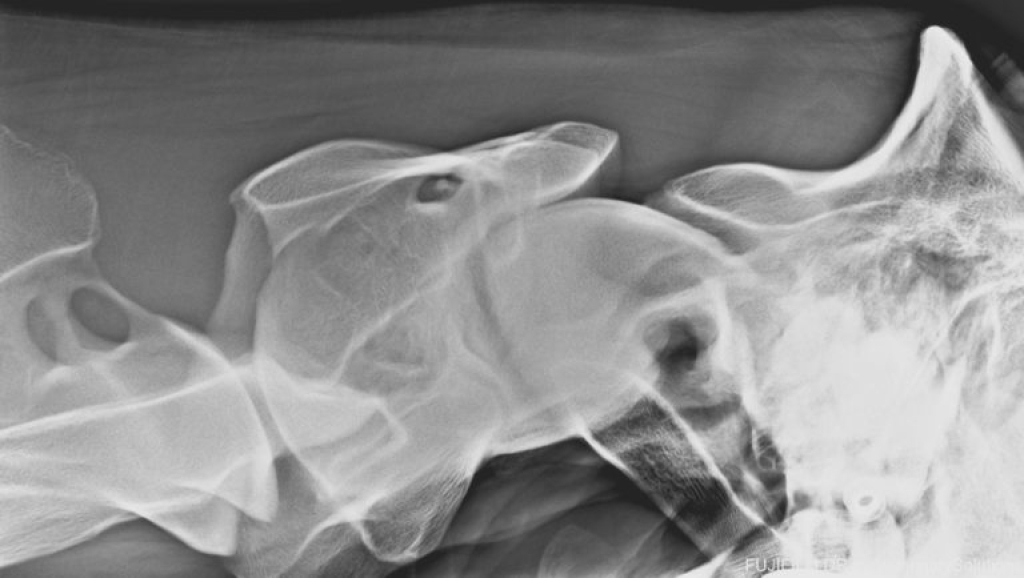 Röntgenfoto van het achterhoofd en de Atlas