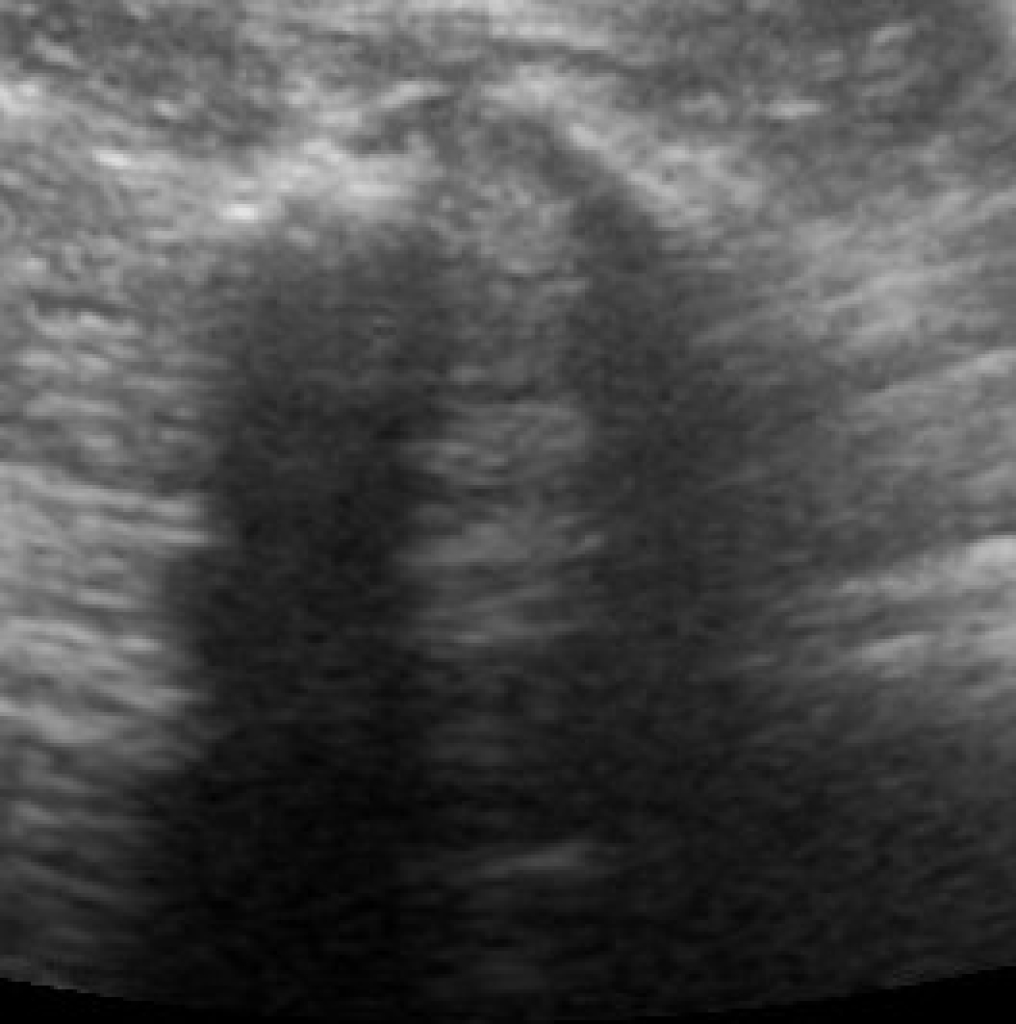 Echobeeld van een facetgewricht