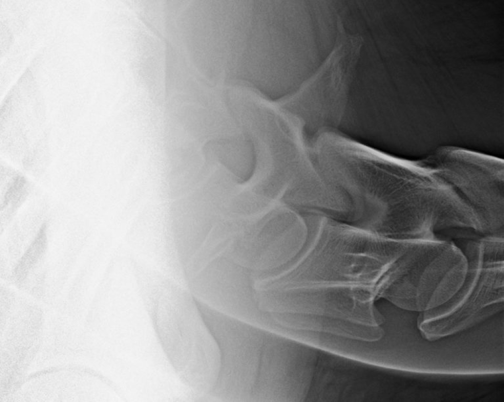 Rontgenopnamen T1-C7