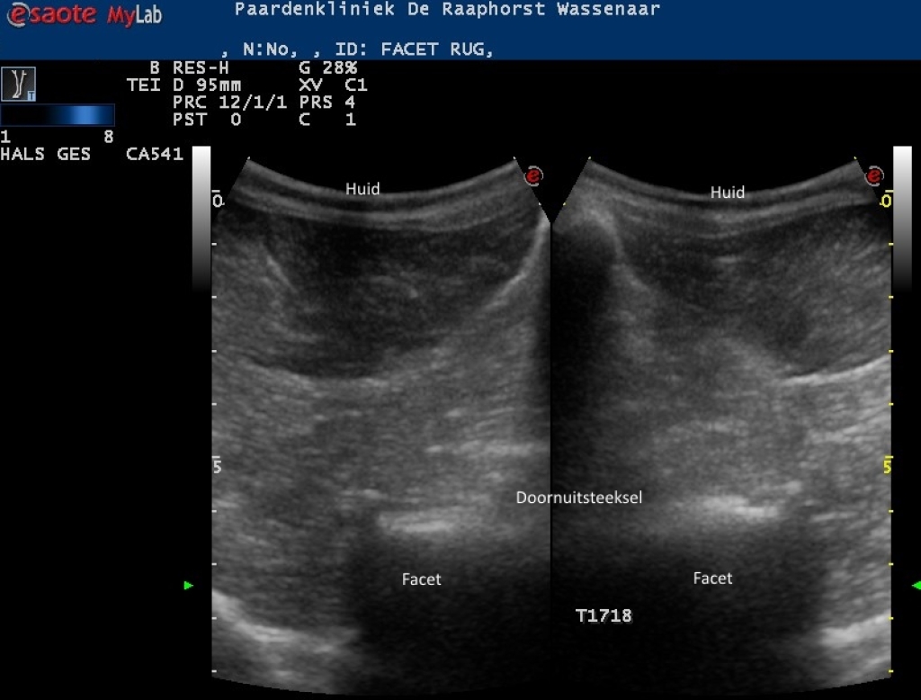 Echografisch beeld van normale facetgewrichten van de borstwervels