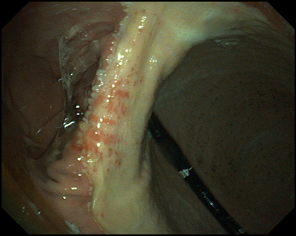 Maagzweren in het verhoornde deel van de maag