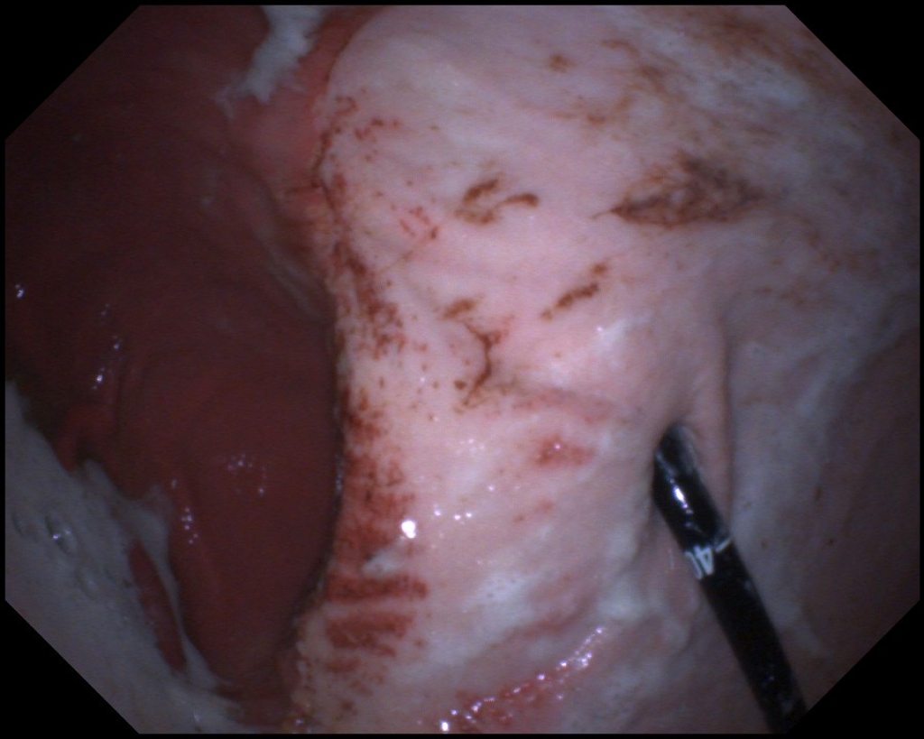 Maagulcera net boven de margo plicatus