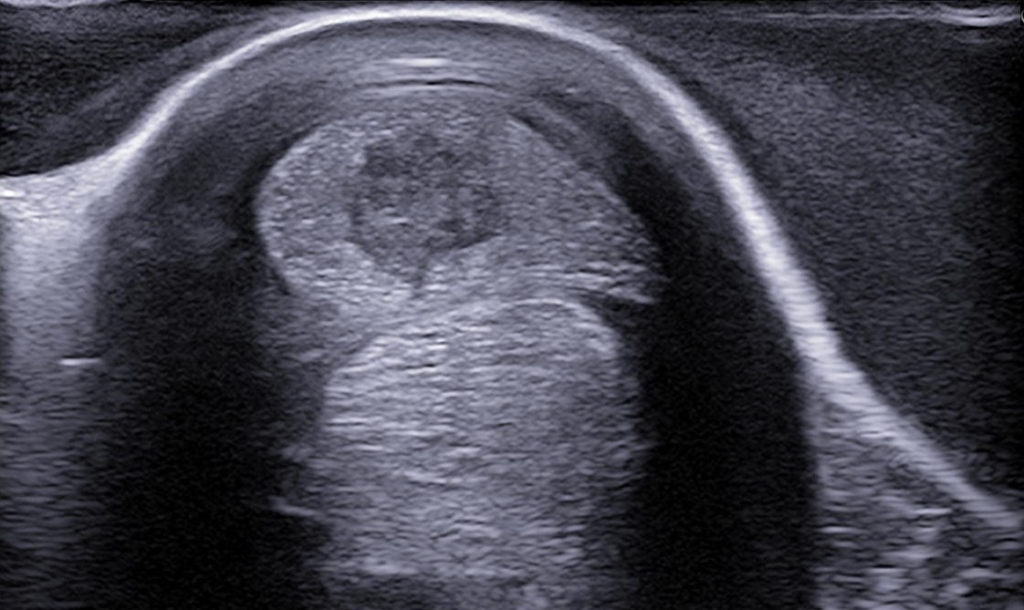 Een oppervlakkige buigpees blessure (lengte richting)