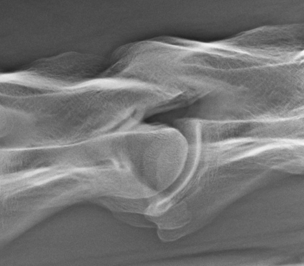 Facetgewricht röntgen