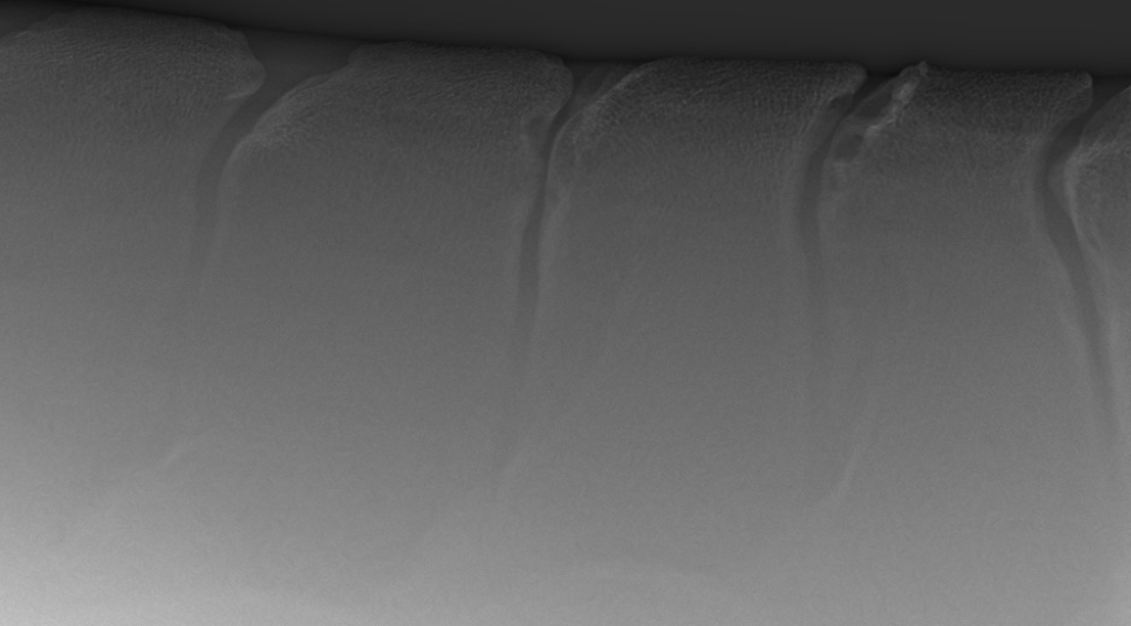 Röntgenopname met daarop botverdichting en botoplossing van de borstwervels