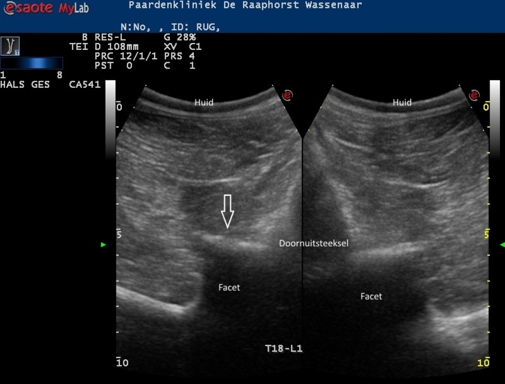Echobeeld van een licht artrotisch facetgewricht (links) op de thoracolumbale overgang
