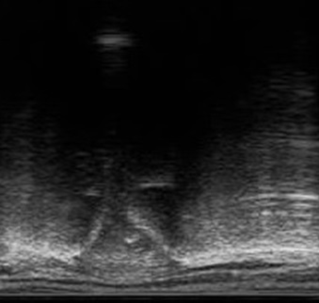Echo: Lumbosacrale overgang