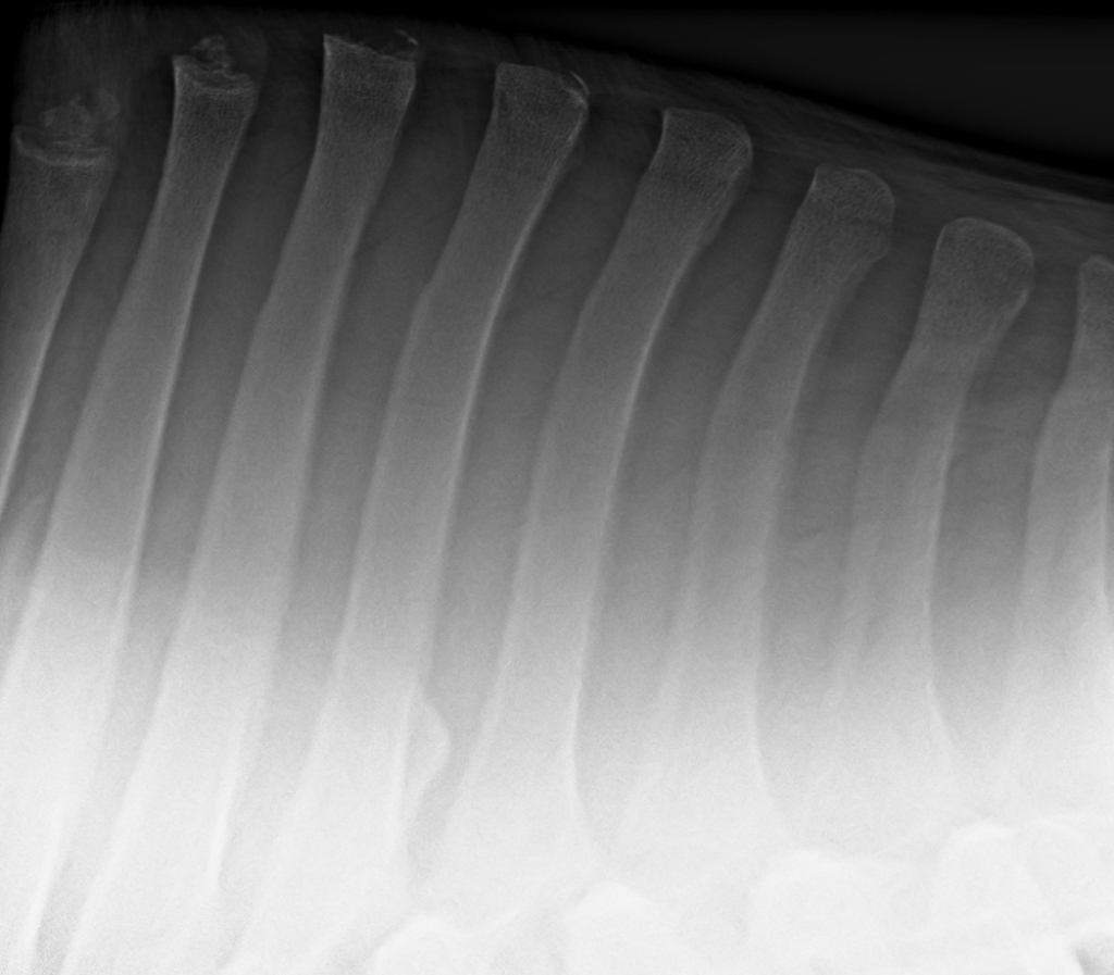 Röntgenfoto van de doornuitsteeksels van de schoft