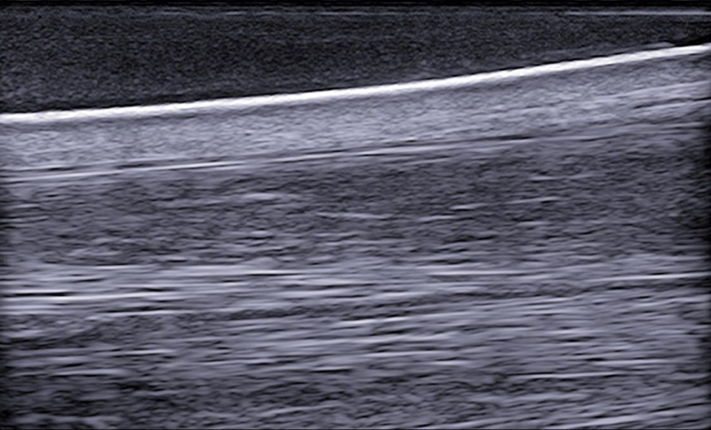 Een oppervlakkige buigpees blessure (dwarsdoorsnede)