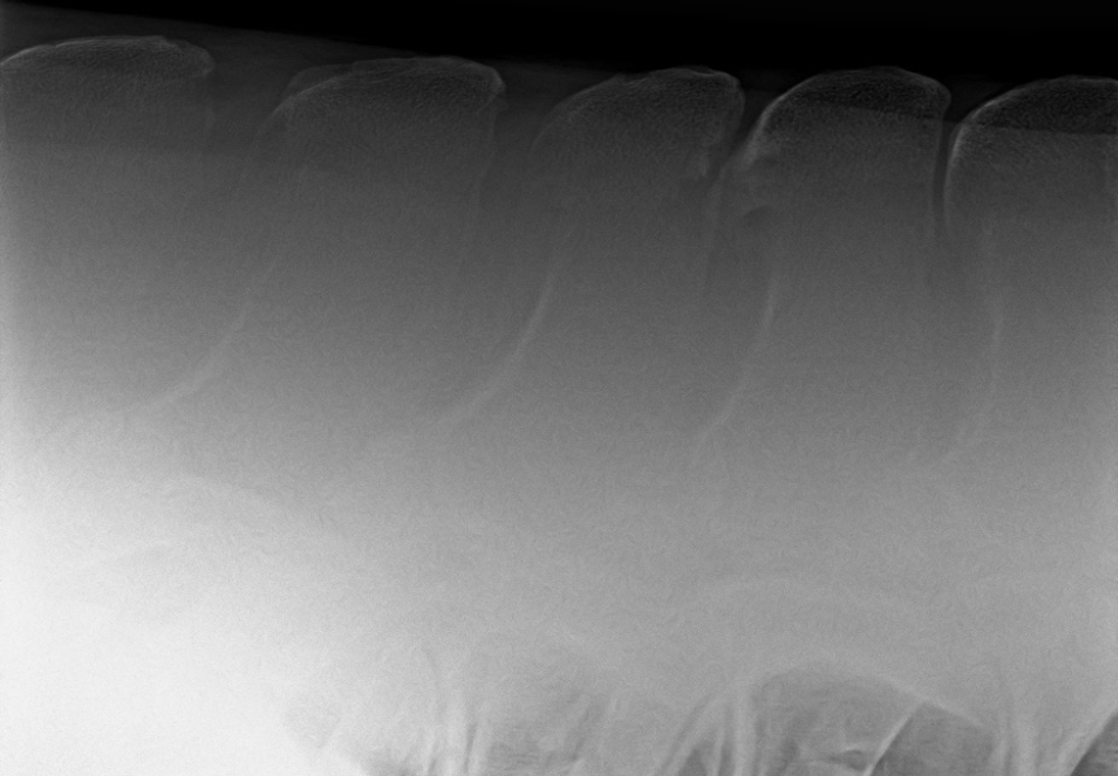 Röntgenopname met vormveranderingen van de doornuitsteeksels met daarbij ook botoplossing