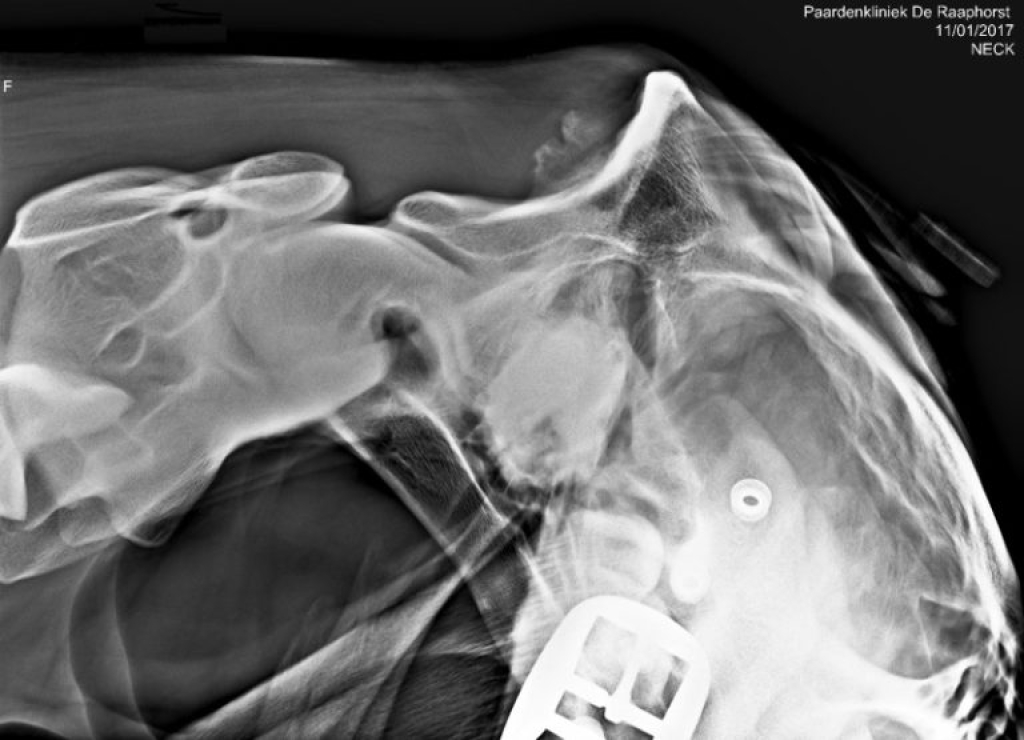 Röntgenfoto van benige nieuwvorming op het achterhoofd