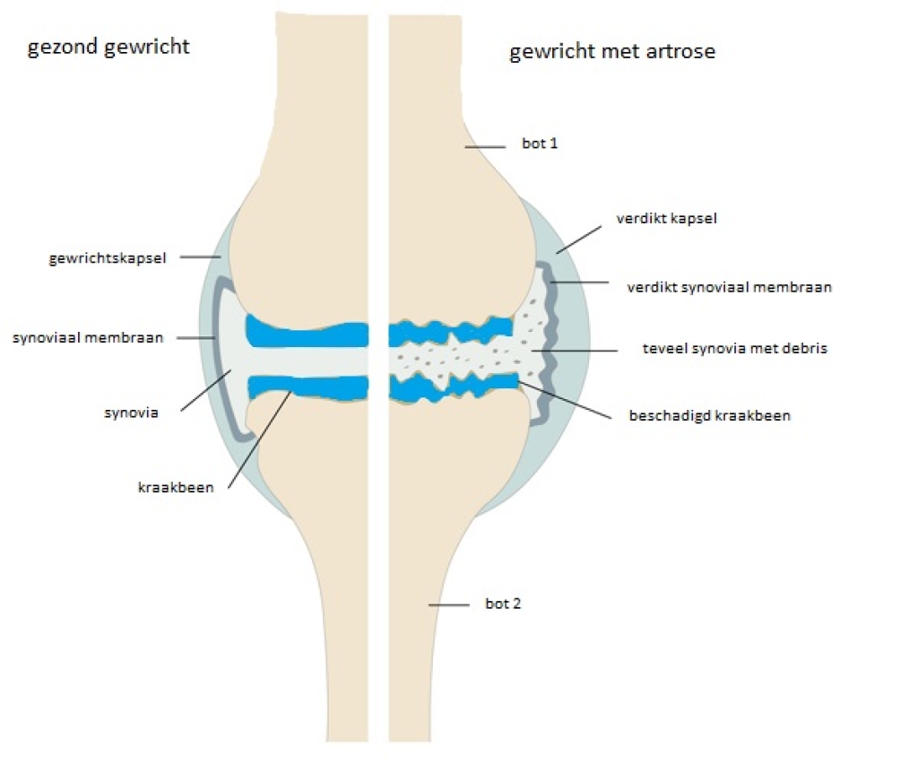 Gezond gewricht vs artrotisch gewricht
