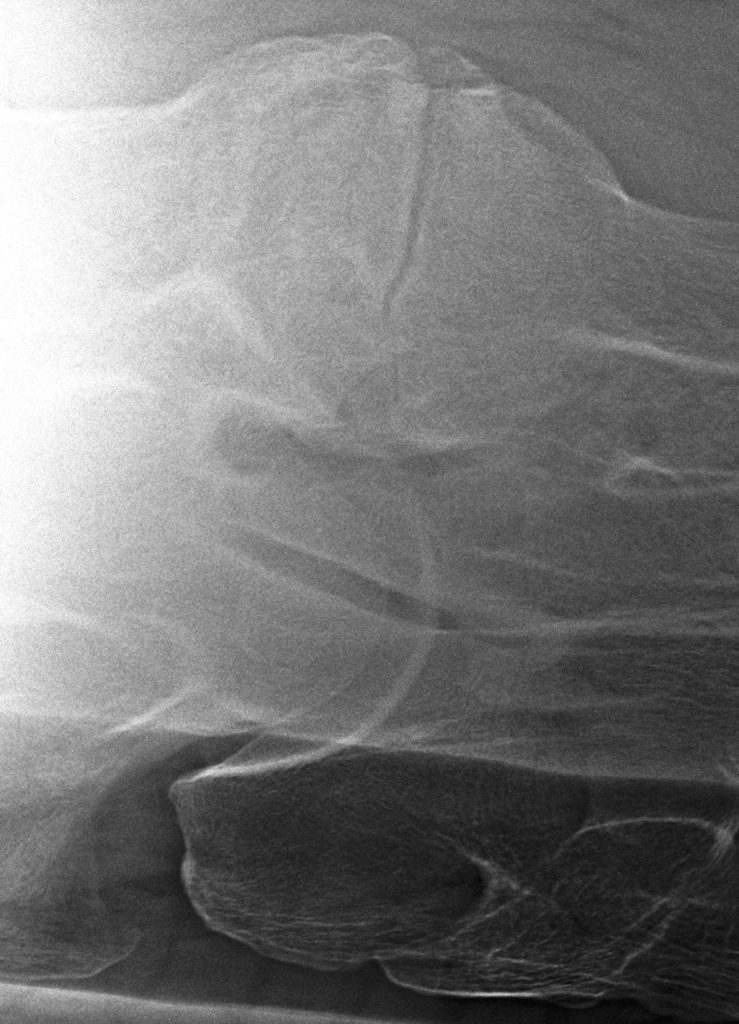 Uitprojectie breuk facetgewricht