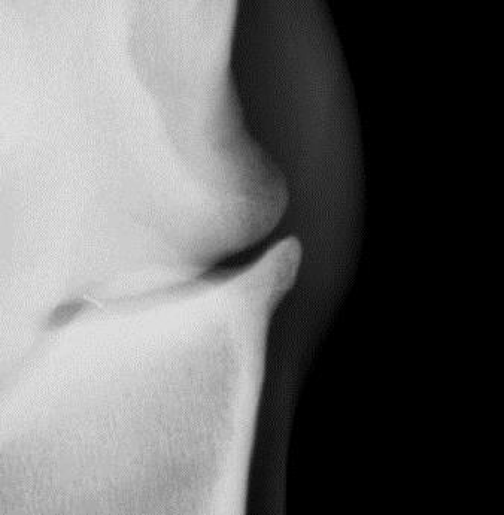 Uitvergroting van hetzelfde gewricht.