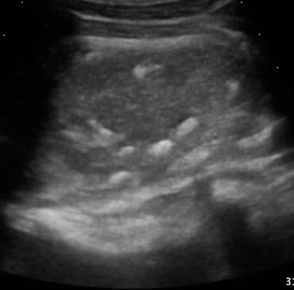 Echobeeld: slijmbeursontsteking met mineralisaties